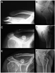 Additional imaging of the lung apices • properly positioned (not rotated or angulated): Conventional Anteroposterior Radiograph Stress View With A 5 Kg Load Download Scientific Diagram