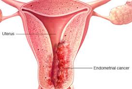 The better we know and understand our vulvas and vaginas, the more likely we are to know. Health Talk How To Protect Yourself From Uterine Cancer Common Symptoms To Watch Out For