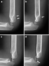 Check spelling or type a new query. The Angled Buckle Fracture In Pediatrics A Frequently Missed Fracture Springerlink