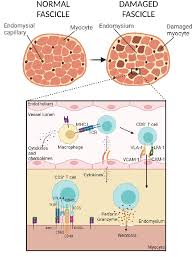 Image result for Polymyositis
