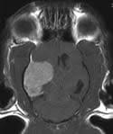 Rimary brain tumors include neoplasms that arise from brain parenchymal tissue. Brain Tumours Fact Sheet Davies Veterinary Specialists
