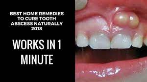 A severe tooth infection will eventually kill the pulp inside the root of the tooth, at which point the tooth will lose sensation. How To Drain A Tooth Abscess At Home Home Remedies For Tooth Abscess To Tooth Abscess Abscess Tooth Natural Headache Remedies
