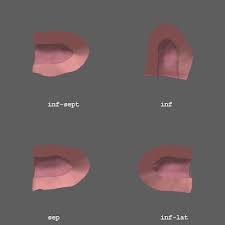 Check spelling or type a new query. Nuclear Stress Test Cardiovascular Interventions Orlando