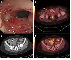 Cervical cancer stage ib2 and ib3. A 56 Year Old Woman Was Suffered From Uterine Cervix Cancer And Download Scientific Diagram