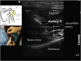 Image result for Axillary Nerve Block