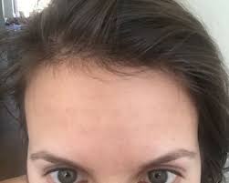 How I Cleared My Tiny Bumps On Forehead Once For All Forehead Bumps Forehead Acne Little Bumps On Forehead