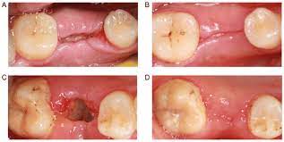 Healing Of Local Gingival Tissue Following Tooth Extraction Gingival Download Scientific Diagram