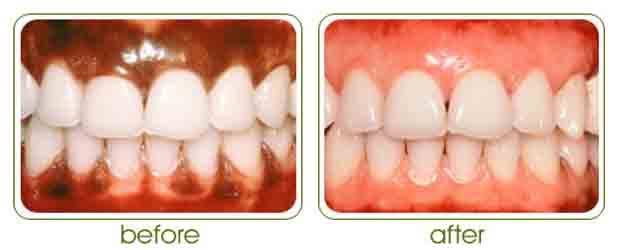 Image result for gum depigmentation"