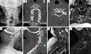 Cancer cells can spread from the thyroid to other parts of the body. Bone Metastases From Differentiated Thyroid Carcinoma Current Knowledge And Open Issues Springerlink