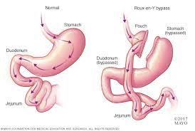 Dumping Syndrome Beacon Health System