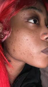 Hoping someone can give me advice. I've always struggled with my skin, it  makes me incredibly self conscious. The past three years or so I've been  struggling with all these little white