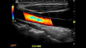 Normal Carotid Duplex Ultrasound Diagnostic Medical Sonography Ultrasound Sonography