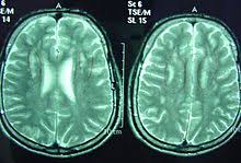 Sjogren Larsson Syndrome Wikipedia
