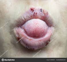 Image result for Puchýře na jazyku