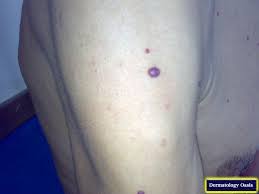 A cherry angioma (also commonly called cherry hemangiomas, campbell de morgan spots, or senile angioma) is a bright red or purple spot made up of blood vessels. Cherry Angioma Dermatology Oasis
