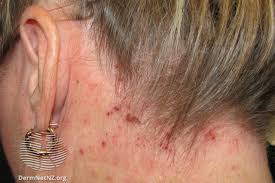 Image result for white scabs on the head in children