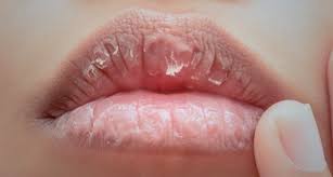 Tetapi sesetengah orang boleh mengalami kekeringan bibir yang. 8 Tips Paling Efektif Untuk Elak Bibir Merekah Cara Merawat Barulah Dapat Bibir Mungil