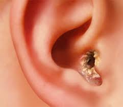 Ear Dryness Ear Infection Outer Ear Infection Swimmers Ear