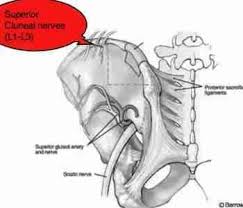 Maignes Syndrome Is Thoracolumbar Pain That Radiates Into The Buttock