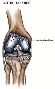 Maybe you would like to learn more about one of these? Arthroscopy Pinnacle Orthopaedics