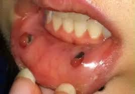 Carrier oil, such as olive or safflower oil. How To Remove A Lip Piercing Hole Scar Quora