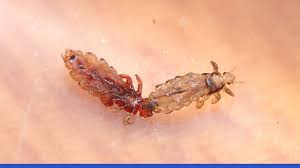 Image result for pubic lice symptoms