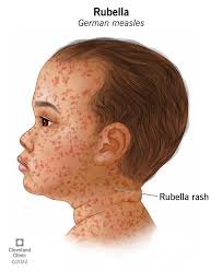Image result for measles