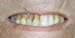 Image result for Lead Poisoning