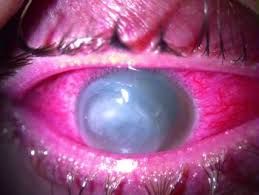 Although infectious ulcers may also be due to fungi, viruses, mycobacteria and protozoa, bacteria are the most common cause of infectious keratitis. Interstitial Keratitis Eye Disorders Msd Manual Professional Edition