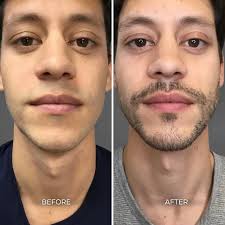 Albuquerque Chin & Jaw Before & After Gallery: Chrome Aesthetics