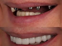 Image result for dental implant