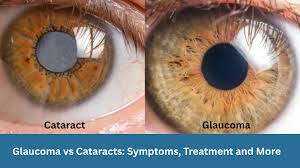 Image result for Glaucoma
