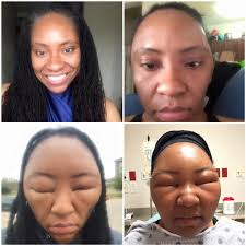 Pics This Woman S Extreme Allergic Reaction Is A Reminder That Not All Henna Is Created Equal Hair Dye Allergy Henna Hair Dyes Henna Hair