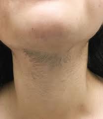 I strongly advise you to look at the before and after pictures of laser hair removal that epione of beverly hills has provided you above, they should be a great resource for you in determining if laser hair removal is appropriate for you. Laser Hair Removal Before Afters Academic Alliance In Dermatology