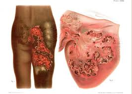 Image result for Tertiary Syphilis