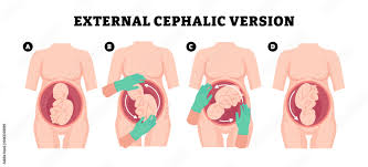 Image result for External Cephalic Version