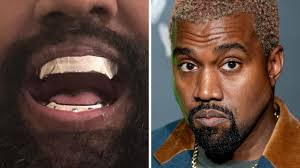 Kanye Wests titanium teeth are permanent, dentist claims | The Mercury