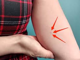 3) birth control delivered to you. What It S Like To Get The Birth Control Implant