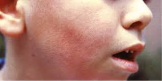 However, hantanvirus is not a new virus and has been infecting humans for decades. Fever And Rash In The Pediatric Population Chapter 52 Emergency Management Of Infectious Diseases