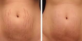 When a person grows or gains weight really quickly (like during puberty), that person stretch marks happen when the skin is pulled by rapid growth or stretching. How Dermaroller Before And After Stretch Mark Treatment Works Rejuviss