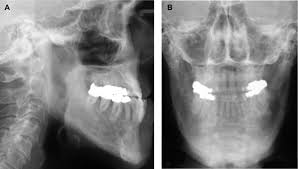 Clinical And Microstructural Findings In Paget Disease Of The Entire Mandible Journal Of Oral And Maxillofacial Surgery