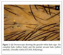 This bulb is where new hair cells replenish old hair cells and deliver nutrients through the hair shaft's length. Two New Signs Halo Sign And Wipeout Sign To Differentiate Black Dots From Hair Dust On Trichoscopy