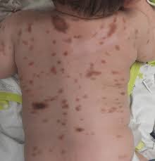 Image result for Urticaria pigmentosa children
