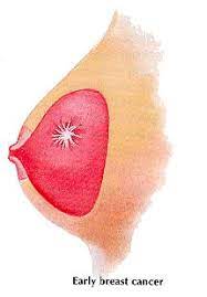 Ductal carcinoma in situ (dcis): Different Kinds Of Breast Lumps Stony Brook Cancer Center