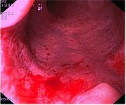 Blut Im Stuhl Abklaren Von Der Analfissur Bis Zum Kolonkarzinom Doctors Today