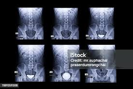 Image result for Intravenous Pyelogram