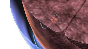 Often they are caused by chemicals released from the. New Operating Procedure Gives Hope To Early Stage Lung Cancer