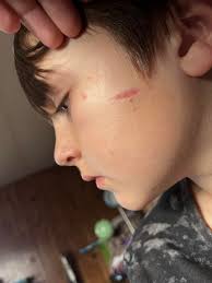 First pic is the first time applying scar stick Second pic is seven days of  applying the scar stick.