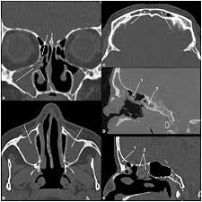 Plos Neglected Tropical Diseases Facial Structure Alterations And Abnormalities Of The Paranasal Sinuses On Multidetector Computed Tomography Scans Of Patients With Treated Mucosal Leishmaniasis