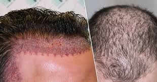 Hair Transplant Market Current Scenario And Trends To 2019